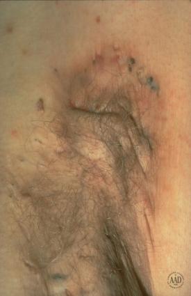 Hidradenitis Suppurativa