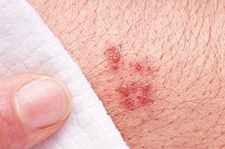 Poison oak rash