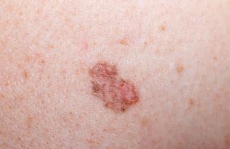 Basal cell carcinoma