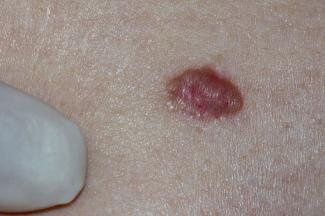 Basal cell carcinoma