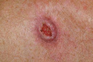 squamous cell carcinoma