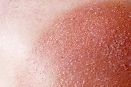 Sun poisoning rash