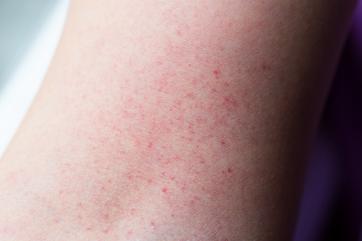 dengue fever rash