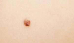 stage 0 melanoma on skin