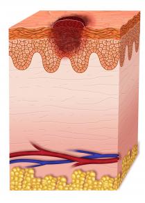 stage 0 melanoma