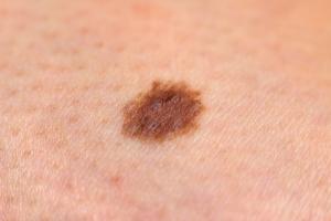 micro invasive melanoma