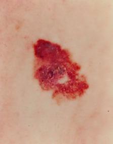 stage 2 melanoma on skin