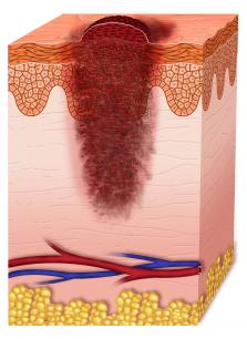stage 2 melanoma