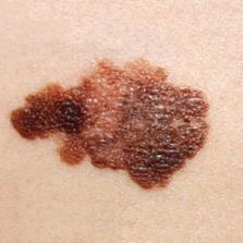stage 3 melanoma on skin
