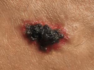 stage 4 melanoma on skin
