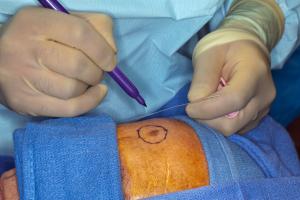 melanoma treatment with wide local incision