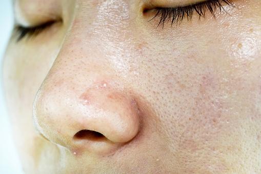 womans face with blackheads