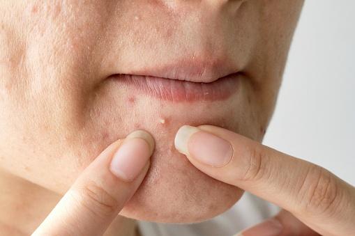 womans face with whiteheads