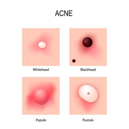 types of acne