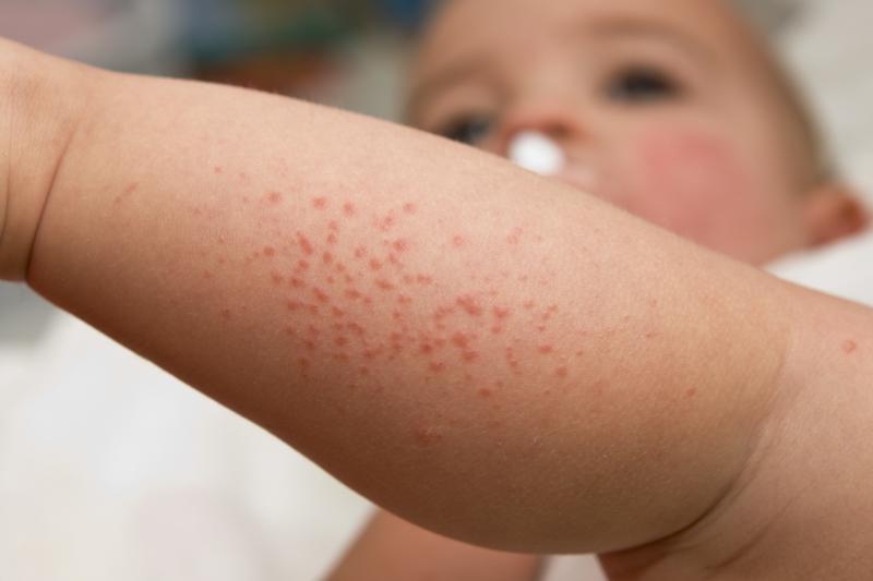 Baby Rash
