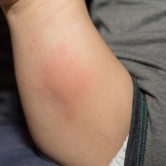 Baby with rash