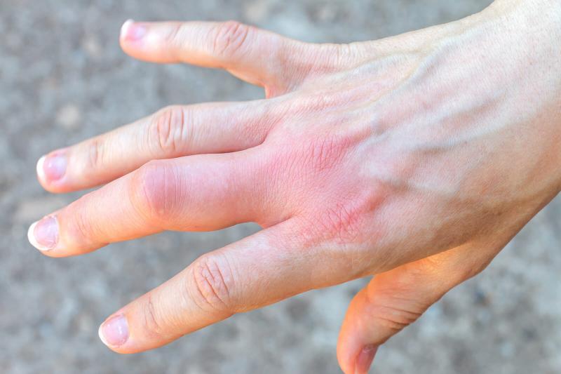 a swollen red finger after a bee bite