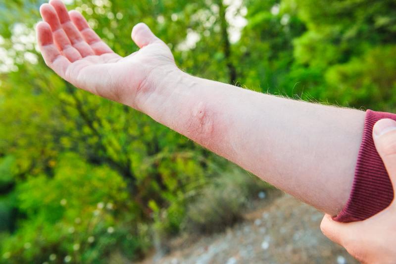 Double wasp bite on an arm