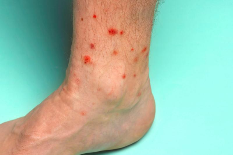 Foot with summer insect bites