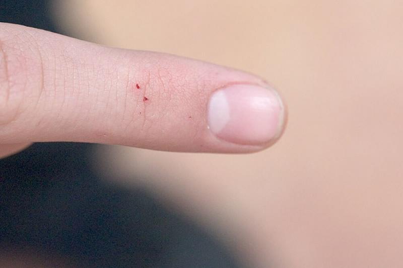 Black widow spider bite