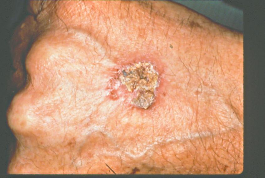 Early Skin Cancer Pictures LoveToKnow