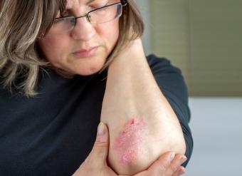 Psoriasis on Elbow