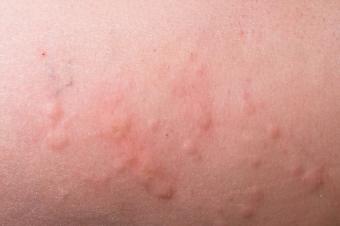 Skin Irritation