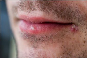 Fever blister image