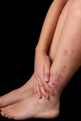 Legs with atopic eczema.