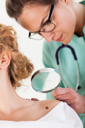 melanoma