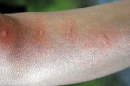 Bug Bites That Blister | LoveToKnow