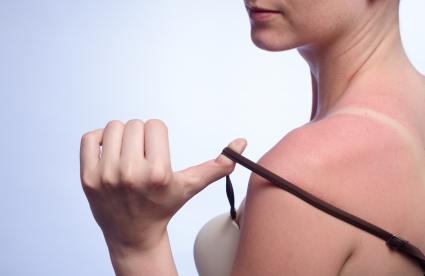 Woman with sunburned skin
