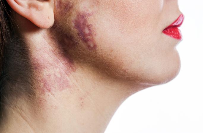 Port wine stain