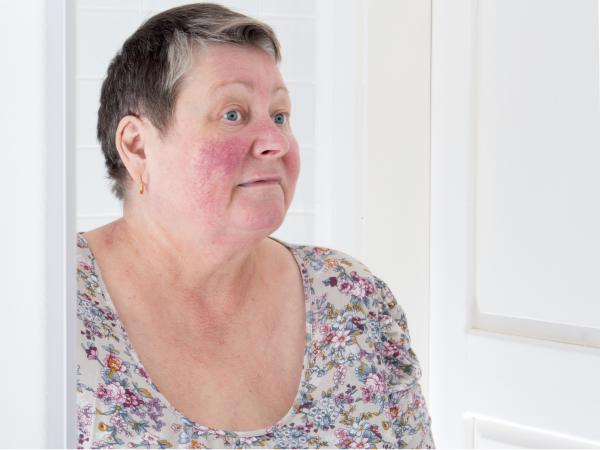 Rosacea