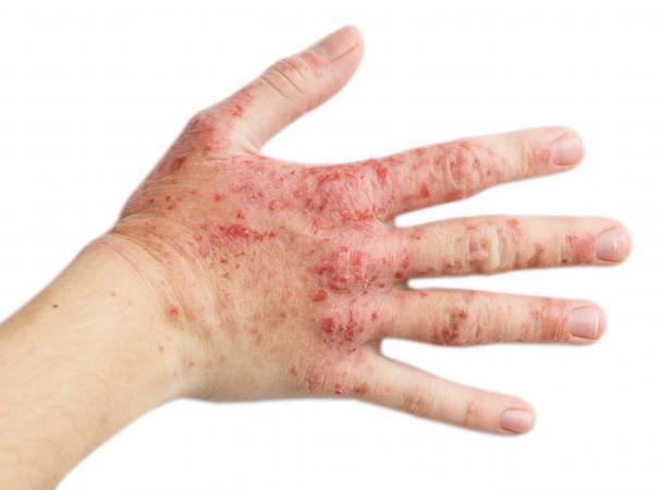 hand of woman with eczema