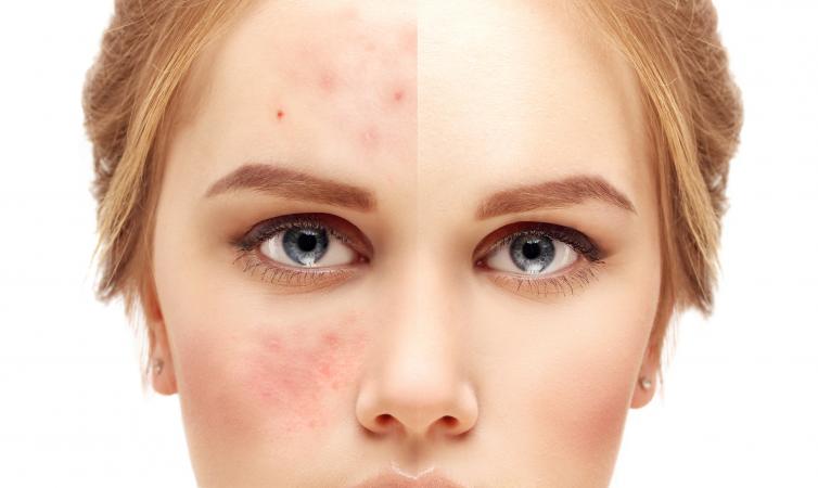 Girl with acne problem