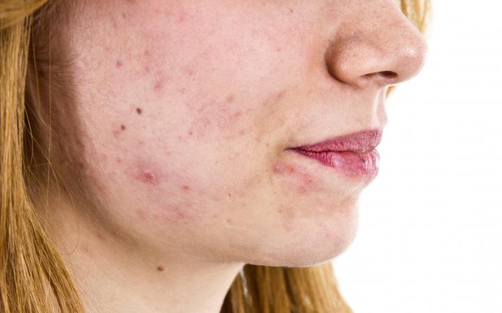 Teenager with acne problems