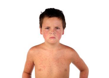 Image of a boy with a measles rash