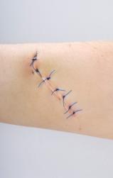 Arm with stitches that will leave scars