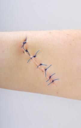 stitches