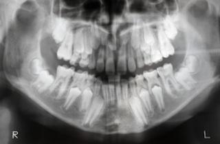 X-Ray of a Jaw