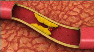 How Does Stress Raise Cholesterol Levels Lovetoknow
