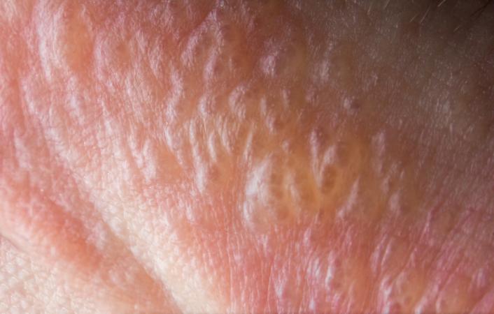 stress bumps