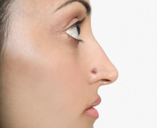 Nose Keloid as a Result of Piercing 