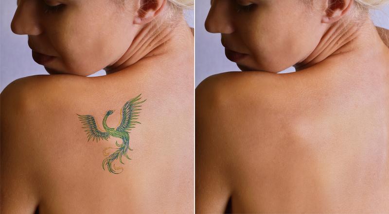 Eliminación de tatuajes con láser antes y después
