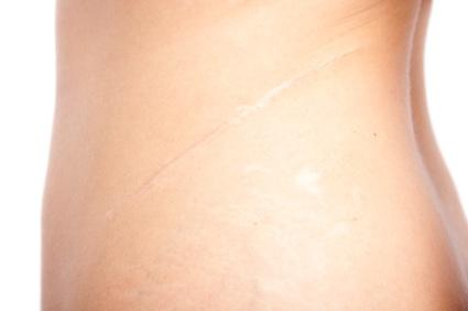 Scar