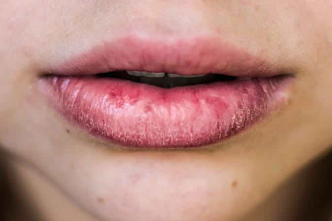 Image result for dry lips