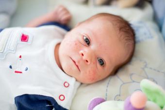 Newborn baby boy with rash on his face